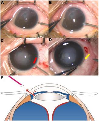 An iris puncture technique for restoration of the anterior chamber in vitrectomy for pediatric vitreoretinopathies